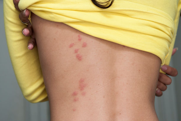 Signs you have Bed Bugs